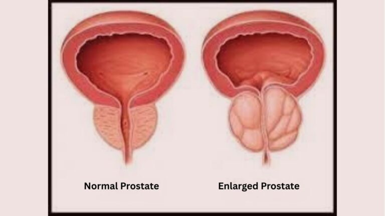 Normal Prostate