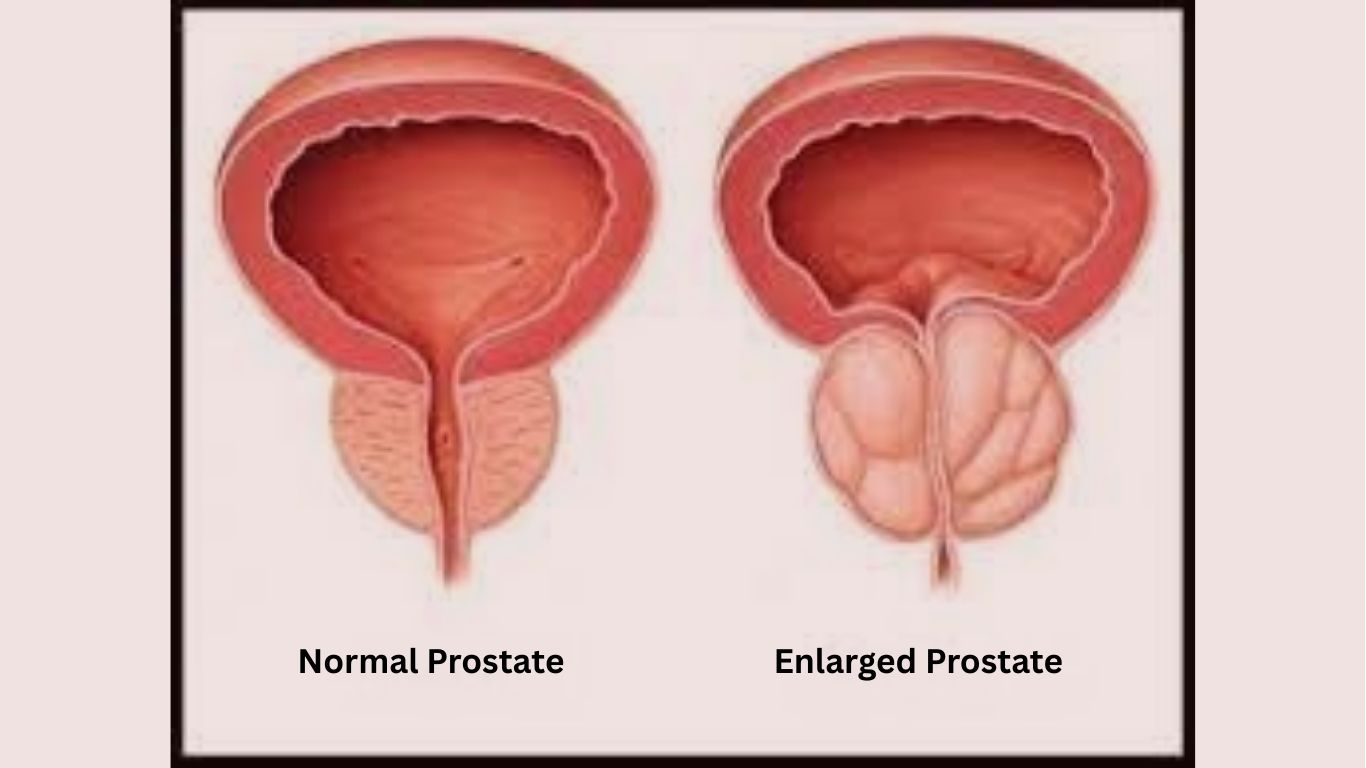 Normal Prostate