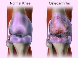 osteoarthritis
