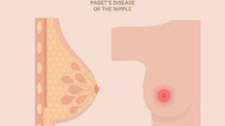 nipple disease