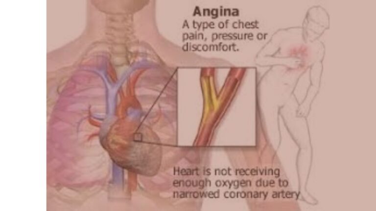 angina pectoris w