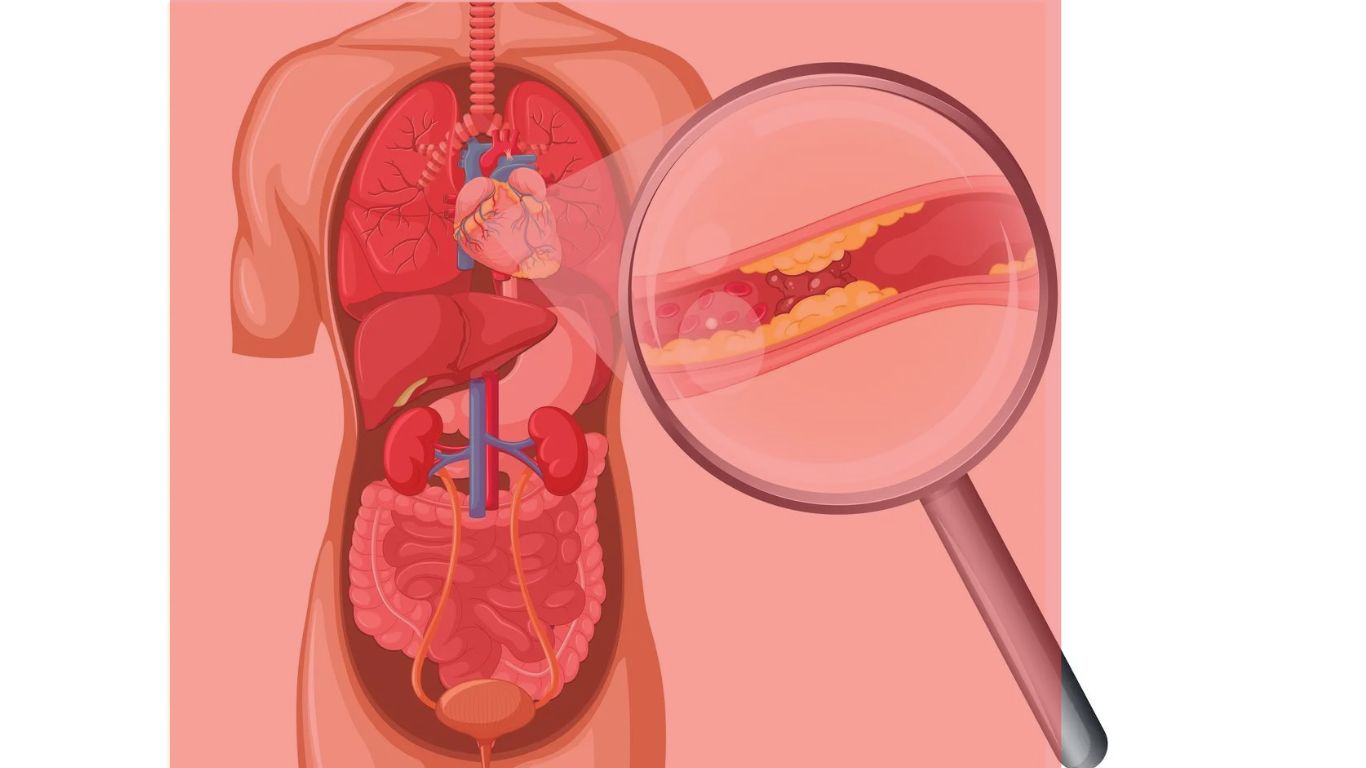 arteriosclosis w