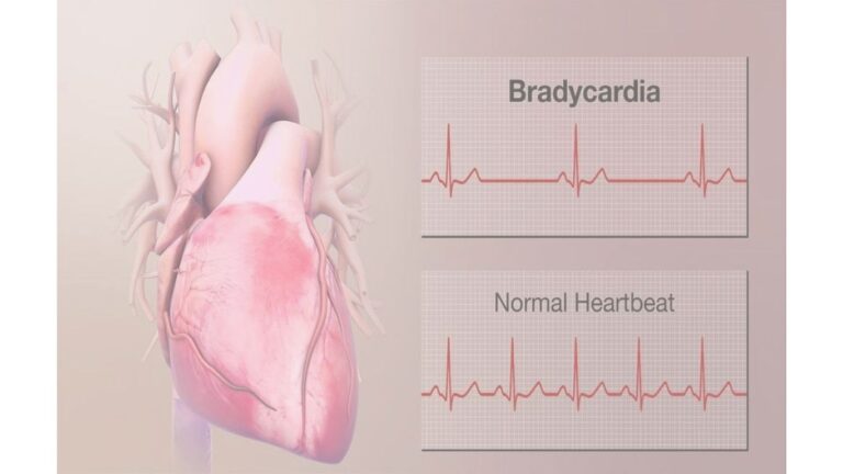 bradycardia w