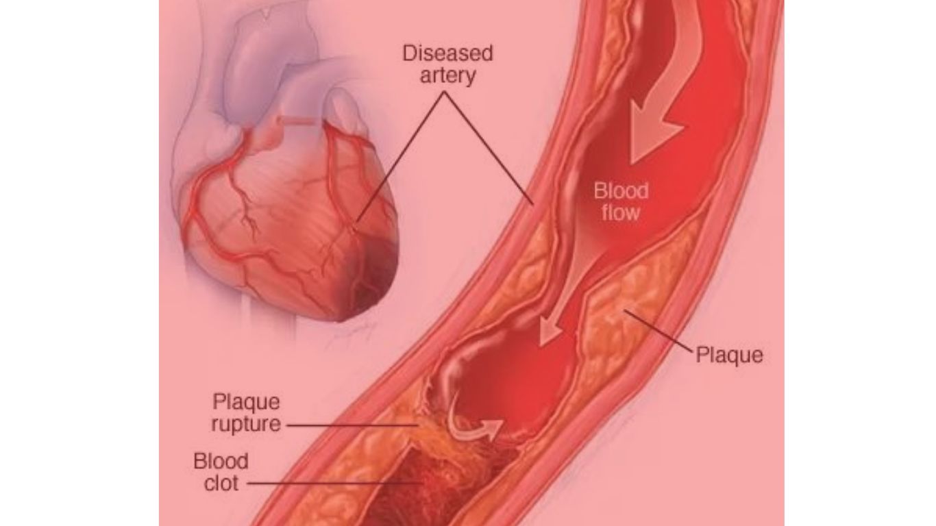 coronary thrombosis