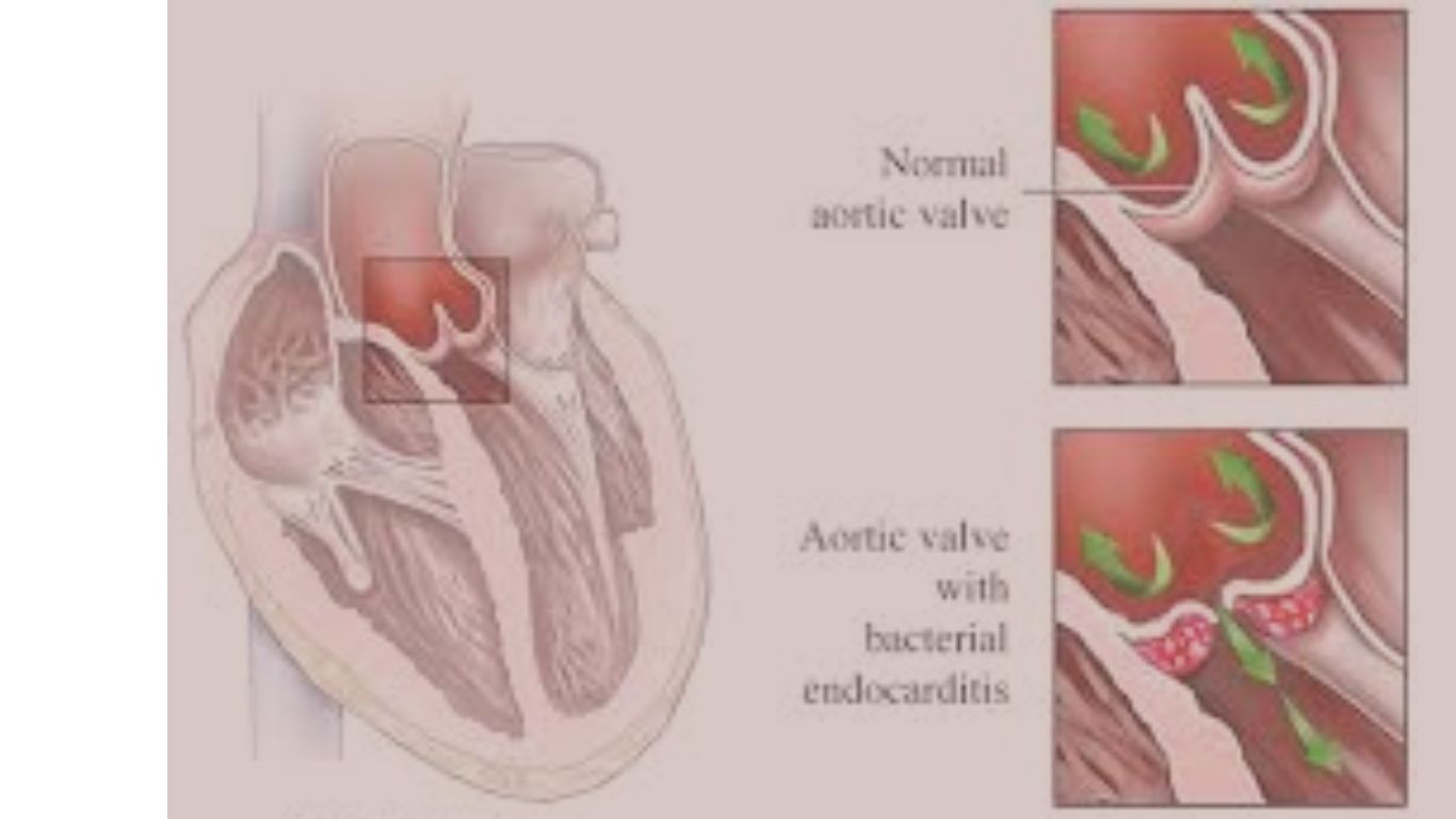 endocarditis w