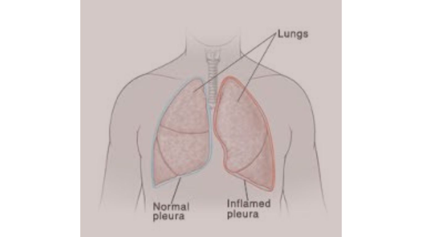 pleurisy w