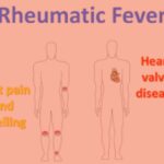 rheumatic fever w