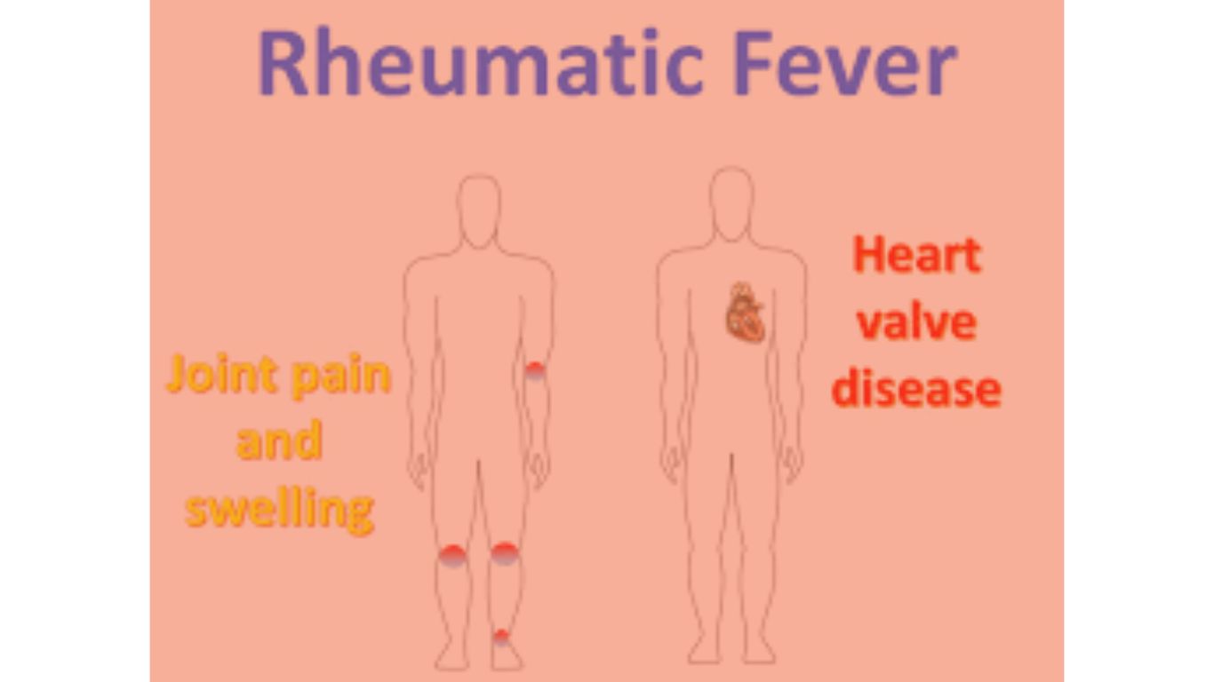 rheumatic fever w