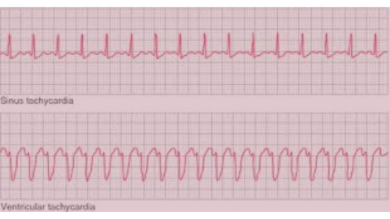 tachycardia w