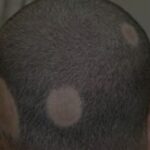 alopecia areata w