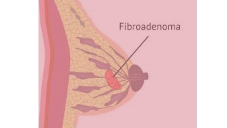 fibroadenoma w