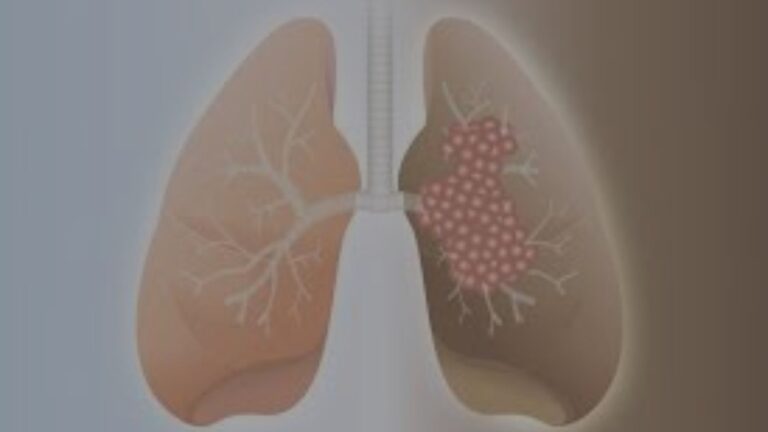 pulmonary fibrosis w