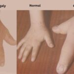 Acromegaly. vs gigantism