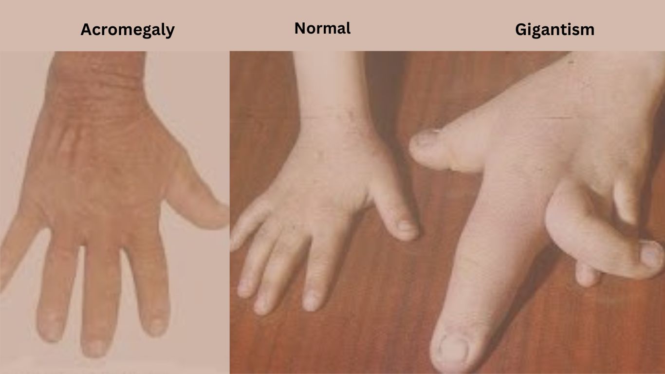 Acromegaly. vs gigantism